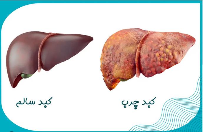 کبد قلب دوم بدن و اهمیت مراقبت از آن